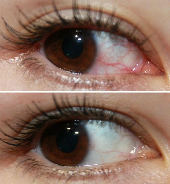 Το Ocuvit λειτουργεί πολύ γρήγορα